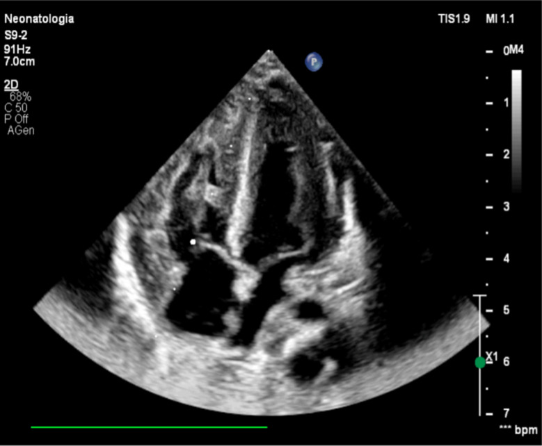 An uncommon case of neonatal asphyxia associated with infantile-onset Pompe disease.