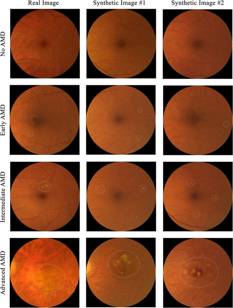Applications of generative adversarial networks in the diagnosis, prognosis, and treatment of ophthalmic diseases.