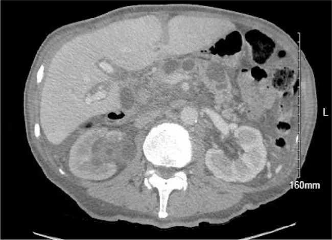 Cold Agglutinin Disease in the Setting of Pancreatic Adenocarcinoma.