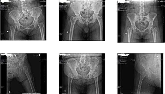 Detection and classification of femoral neck fractures from plain pelvic X-rays using deep learning and machine learning methods.
