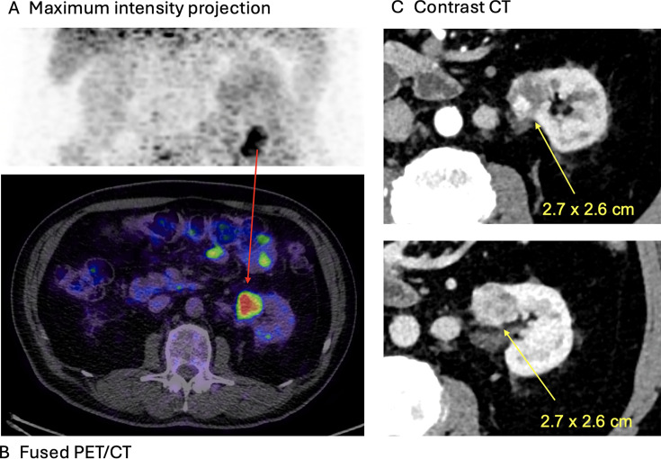 Novel radiopharmaceuticals for molecular imaging of renal cell carcinoma.