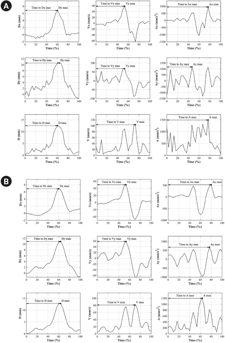 Temporal and Kinematic Measurements of Hyoid Bone Excursion in Patients With Head and Neck Cancer.