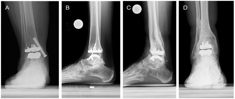 Total Ankle Replacement Outcomes in Patients With Prior Distraction Arthroplasty.