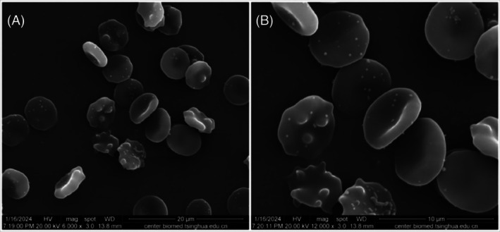 The impact of pressure and temperature on the quality of suspended red blood cells: An ex vivo simulation study.