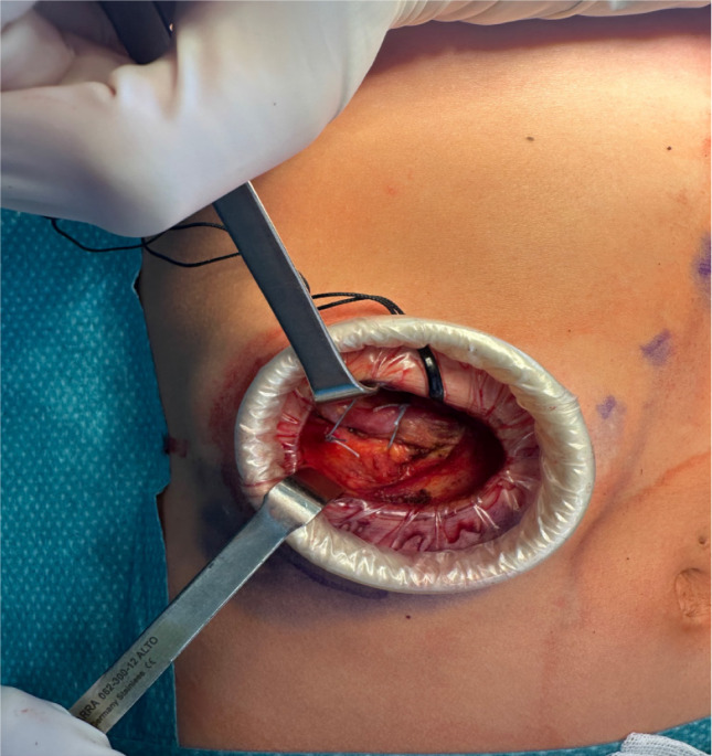Minimally invasive surgical approach for slipping rib syndrome: A case report.