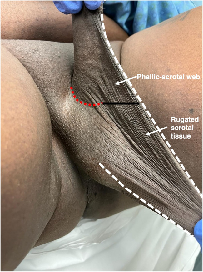 Orchiectomy and scrotectomy as genital gender-affirming surgery: novel surgical technique and patient-reported outcomes.