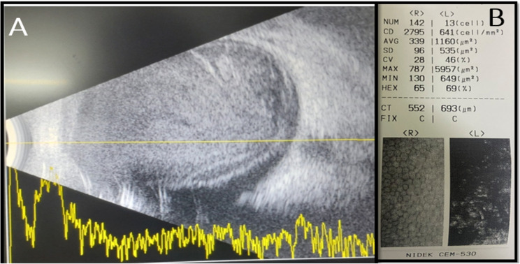 Seasonal Hyperacute Panuveitis from the highest reported altitude: co-occurrence with scleritis - an unusual presentation.