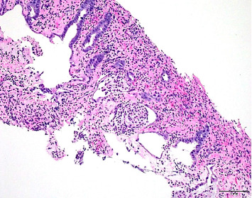 Nonsteroidal Anti-Inflammatory Drug-Induced Granulomatous Colitis: A Case Report and Literature Review of a Vanishing Colonic Mass Mimicking Malignancy.