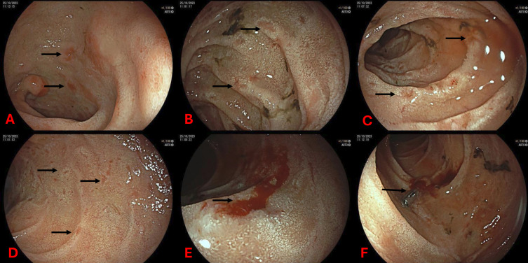 Haematemesis in an elderly patient.