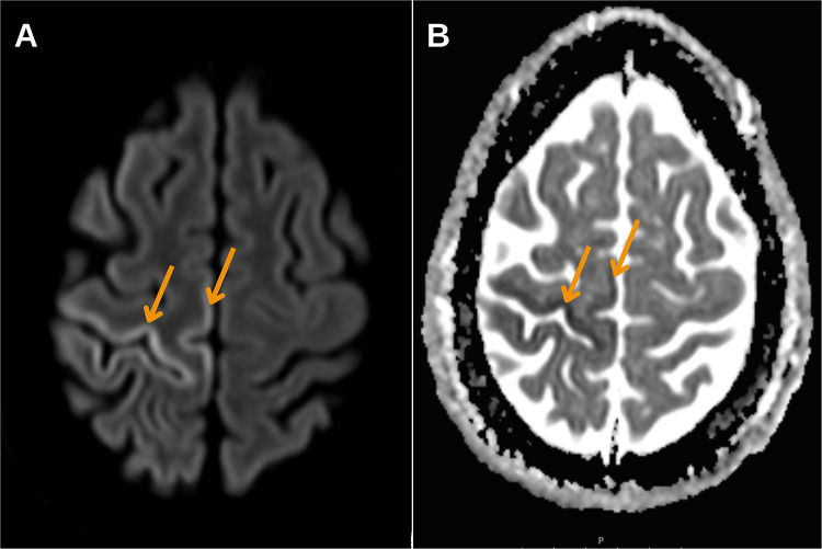 Radiological Findings of Retrograde Venous Cerebral Air Embolism Infarcts: A Case Report and Literature Review.