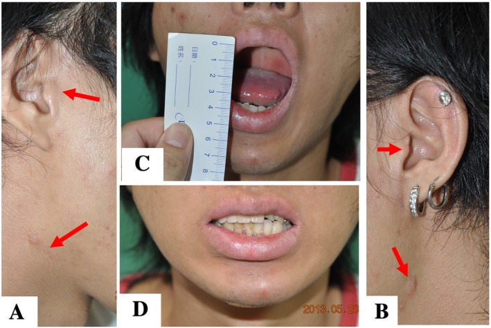 Novel Endoscopic-Assisted Long Plate Approach for Mandibular Condylar Fracture Reconstruction-A Preliminary Study.