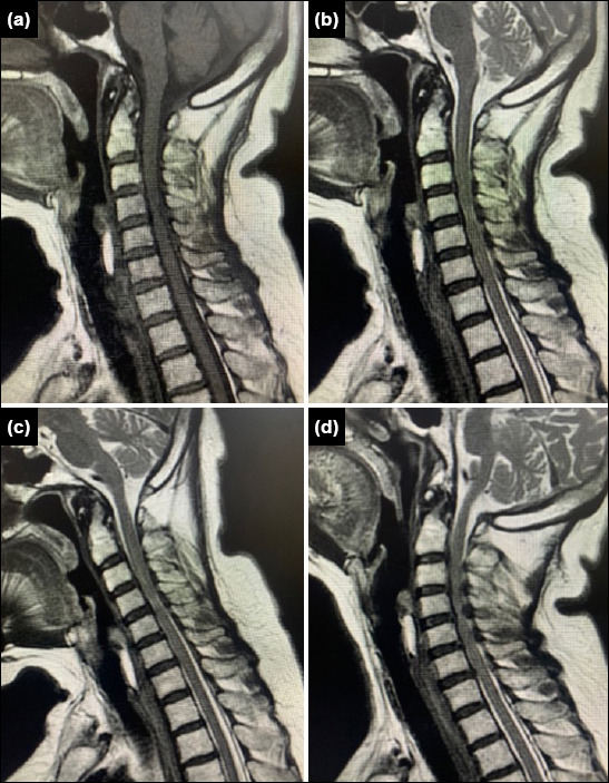 Outcome of cervical cases operated with posterior cervical pedicle screw placement: a single-center retrospective study.