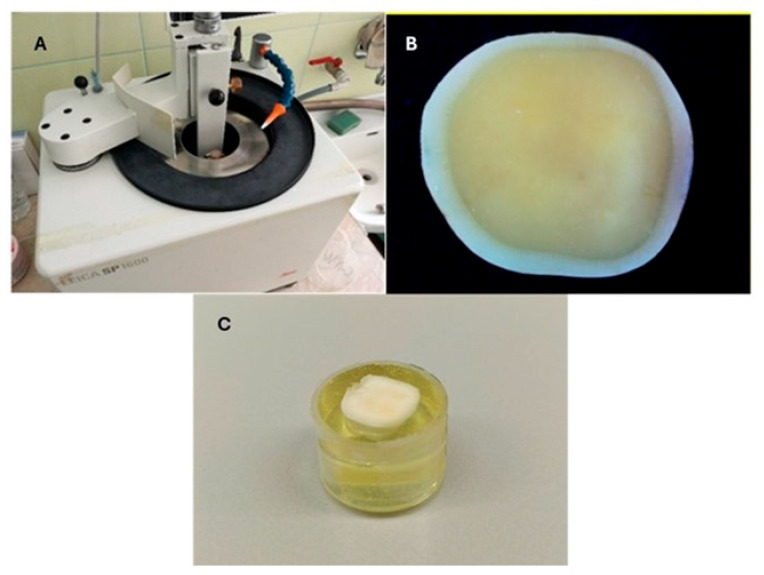 Shear Bond Strength of Self-Adhesive and Self-Etching Resin Cements to Dentin for Indirect Restorations.