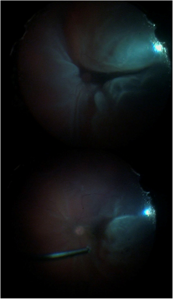 Outcomes of perfluorocarbon liquid vs. posterior retinotomy as adjuncts during pars-plana vitrectomy for the surgical repair of rhegmatogenous retinal detachment: a randomized clinical trial.