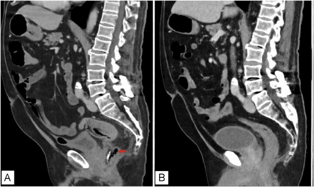 Accidental formaldehyde injection during prostate biopsy: a rare cause of rectal necrosis and perforation. Case report and review of the literature.