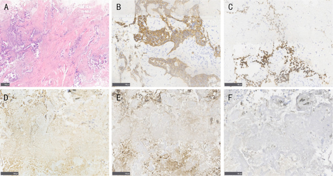 Dual EGFR L858R and KRAS G12A Mutations in Lung Adenocarcinoma: A Rare Case Report and Literature Review.