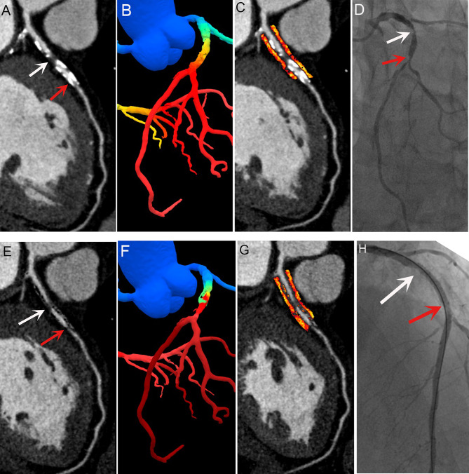 Subtraction fractional flow reserve with computed tomography and pericoronary fat attenuation index enhances the identification of revascularization needs in patients.