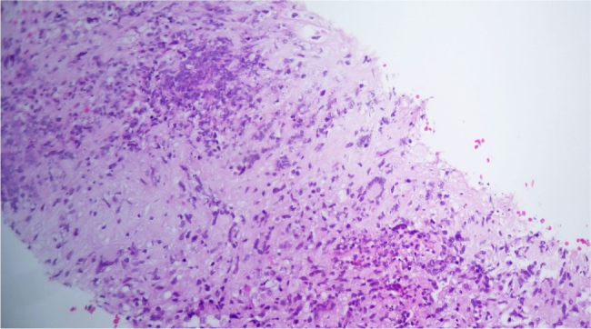 The Balance Between Autoimmunity and Infection: A Case Report of Concomitant Pathology of Pulmonary Nocardia and Granulomatosis with Polyangiitis at Initial Presentation.