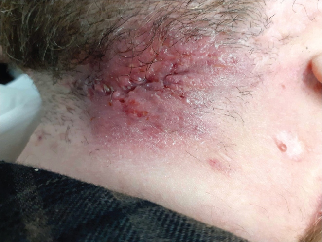 PAPASH Syndrome with a Pathogenic PSTPIP1 p.(Ala230Thr) Variant: A Case Report of Therapeutic Complexity.