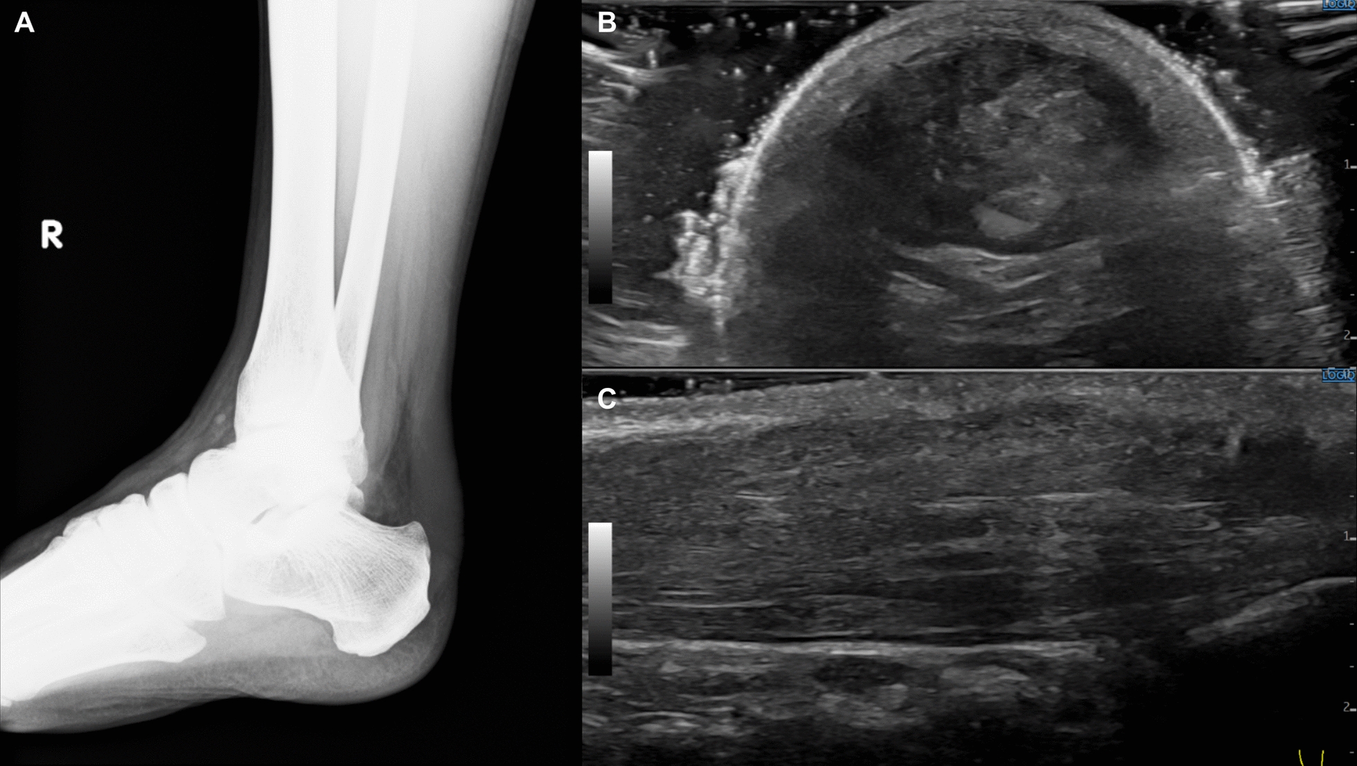 Heterozygous CYP27A1 gene mutation presenting with Achilles tendon xanthoma: a case report.