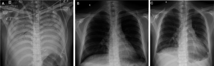 Lung Transplantation Following Paraquat Poisoning: Time to Think.