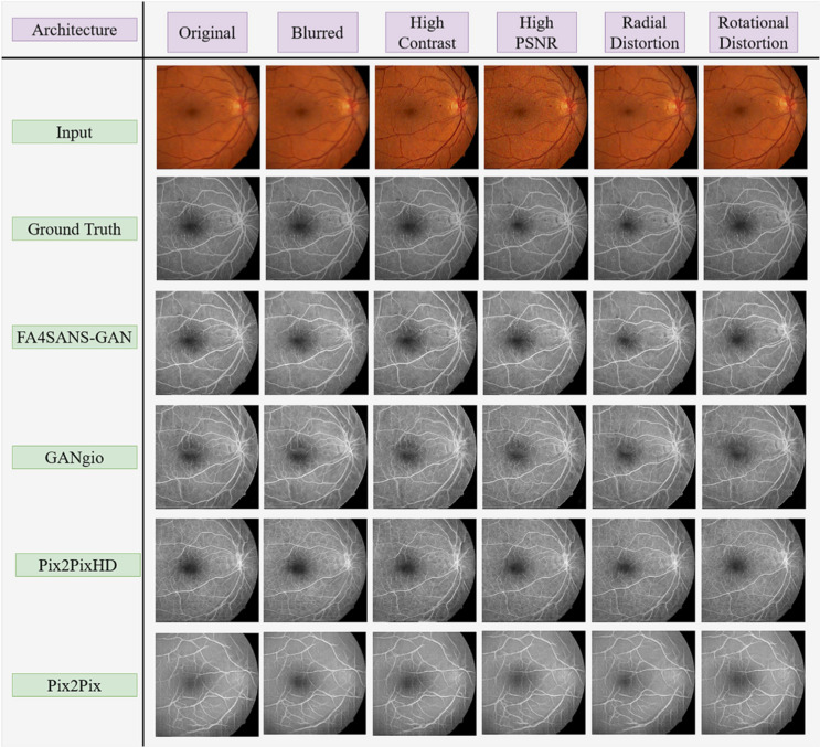 Applications of generative adversarial networks in the diagnosis, prognosis, and treatment of ophthalmic diseases.