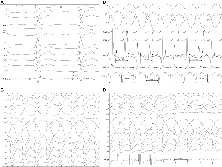 Clockwise bundle branch re-entrant ventricular tachycardia in a teenage patient as the first manifestation of dilated cardiomyopathy associated with the p.Ile512Leu TNNI3k variant: a case report.