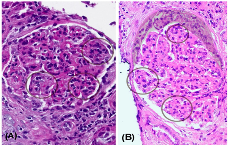 An Unusual Case of Membranoproliferative Glomerulonephritis: Is the Role of Vaccination in Immune Reactivation a Casual or Causal Effect?
