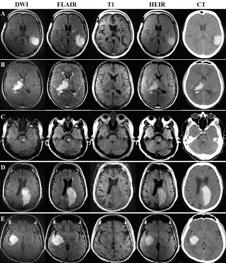 0.23-Tesla MRI to differentiate between ischaemic and haemorrhagic strokes within 24 hours of onset: a combined experimental-clinical study.