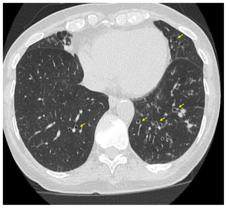 Premature Ventricular Contractions as an Underrecognized Cause of Chronic Cough: A Case of Misdiagnosis in a Patient with Bronchiectasis.