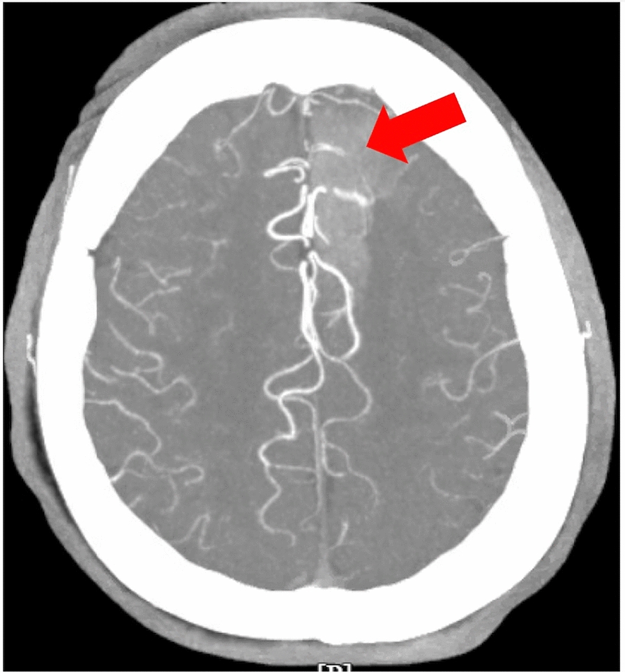 A case of adrenal insufficiency presenting with seizures, complicated by developmental cerebral venous anomaly and Takotsubo cardiomyopathy: a case report.