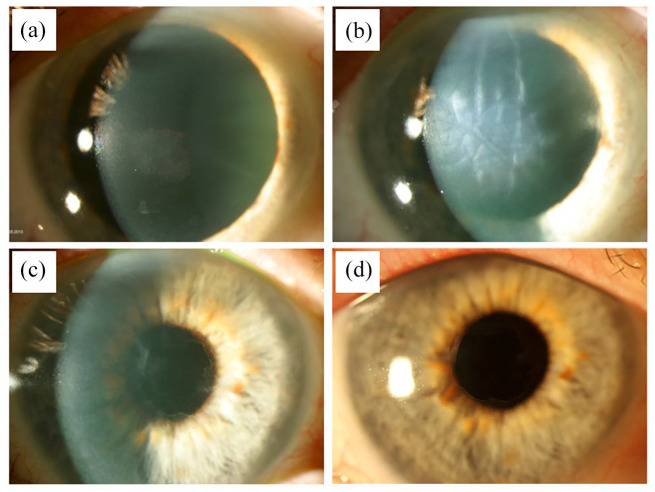 10-Year outcome of descemet stripping only in a patient with Fuchs endothelial dystrophy: a case report.
