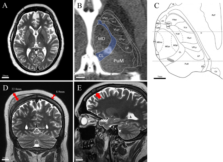 MRI-guided focused ultrasound thalamotomy for neuropathic pain in an adolescent with cranial metastases: illustrative case.