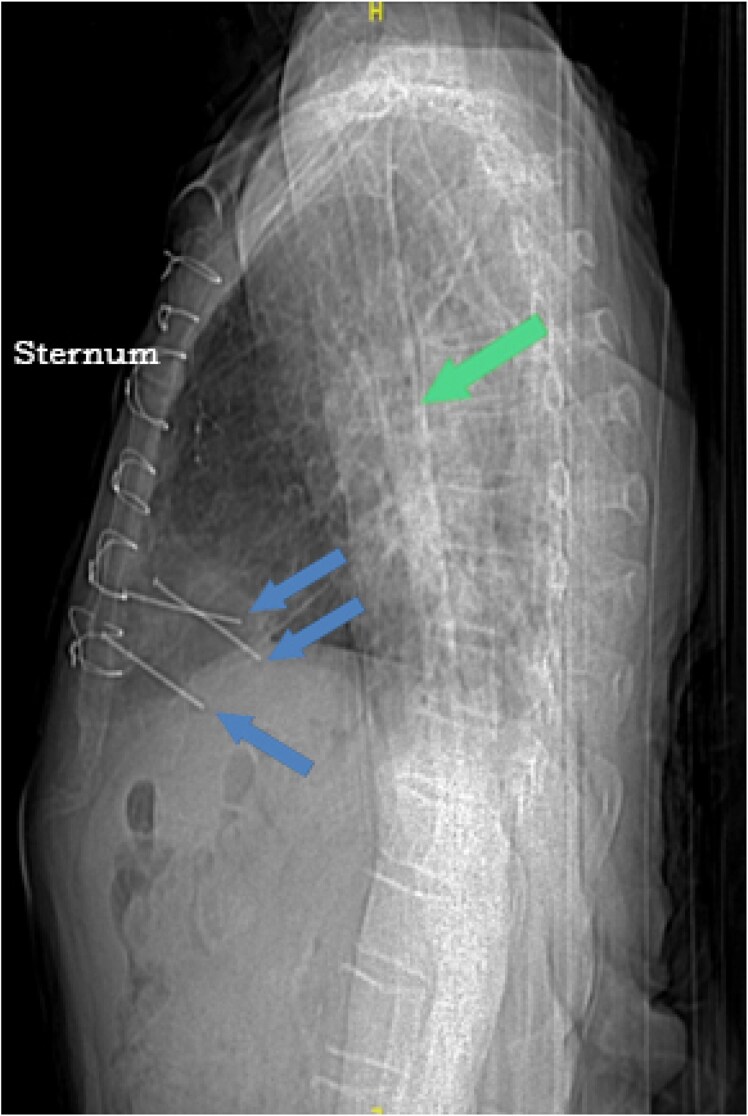 Conservative non-surgical management of penetrating cardiac injury with three retained metal nails: a case report.