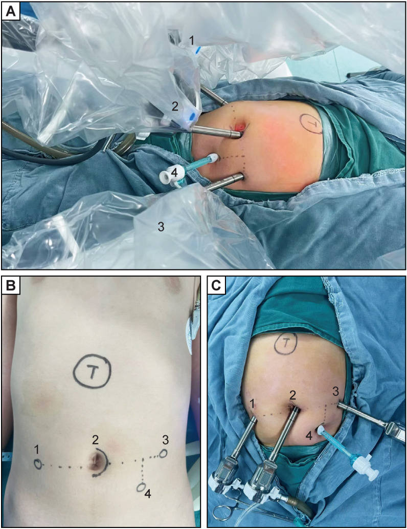 Robotic liver resection for hepatic focal nodular hyperplasia in children: comparison with open surgery.