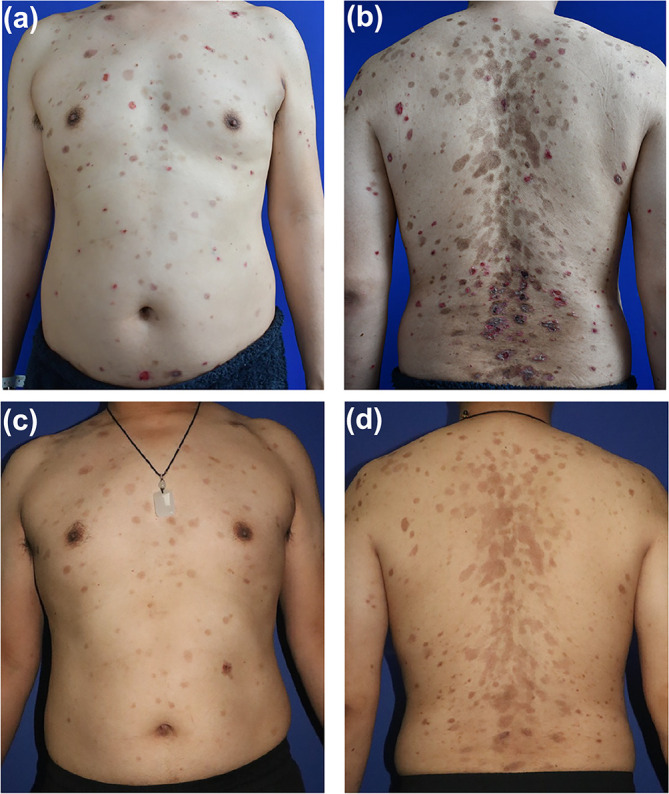 Tofacitinib as a Novel Therapeutic Option for Pemphigus Vulgaris: A Case Report and Mechanistic Insights.