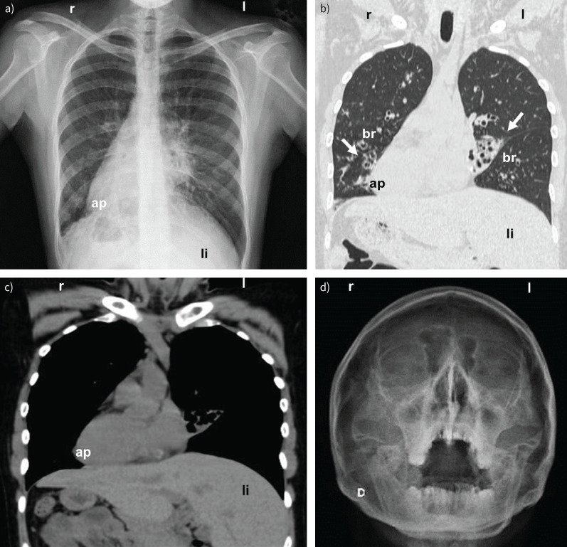 A 28-year-old woman with chronic respiratory symptoms: navigating a diagnostic puzzle.