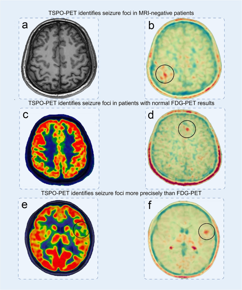 Refining seizure foci localization: the potential of TSPO-PET.