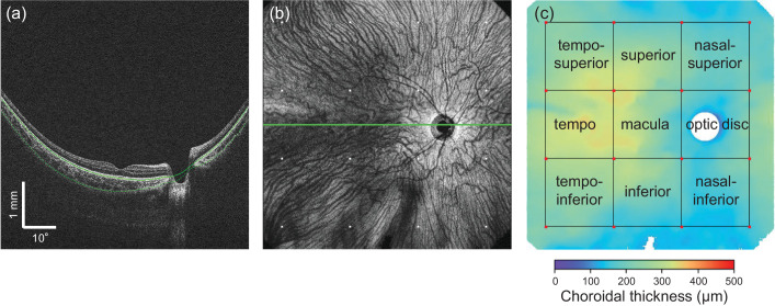 Choroidal Thickness Distribution and Its Association With Axial Length and Spherical Equivalent in Schoolchildren Assessed by Wide-Field Swept-Source Optical Coherence Tomography.