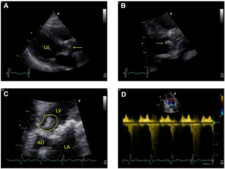 A new case of <i>Tropheryma whipplei</i> infective endocarditis.