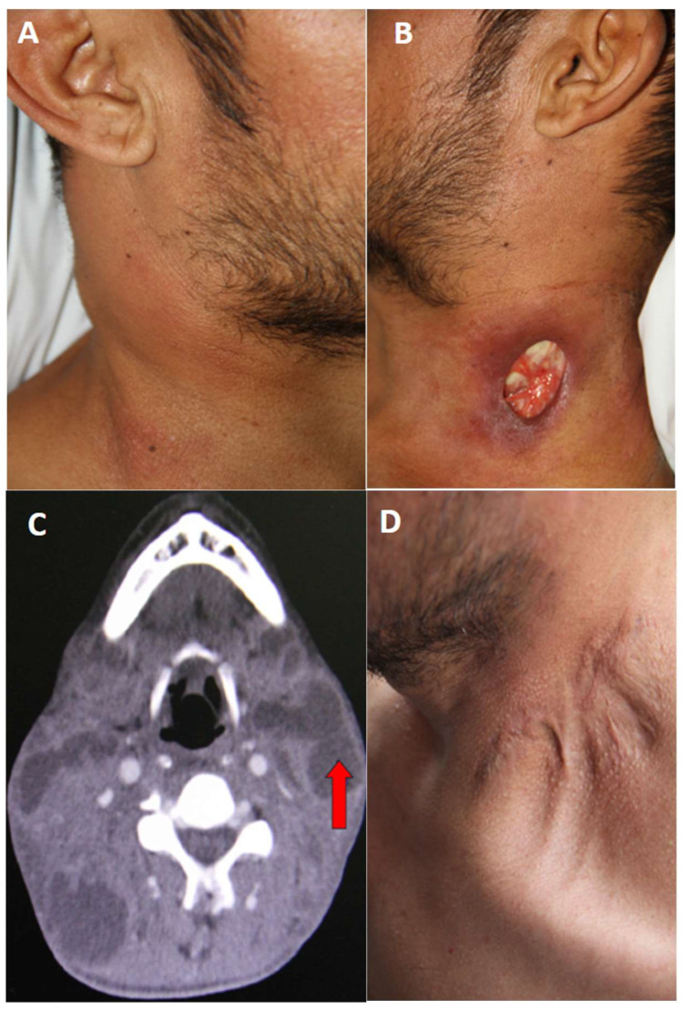 Scrofuloderma, an Old Acquaintance: A Case Report and Literature Review.