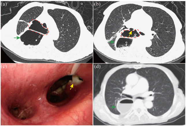 Rare complications after esophagectomy: incidence, clinical features, risk factors, management, and prevention.
