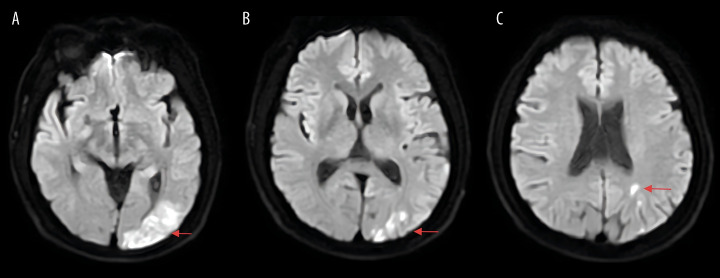 Rapid-Onset Venous Thrombosis After Tibia Fracture: A Case Report.