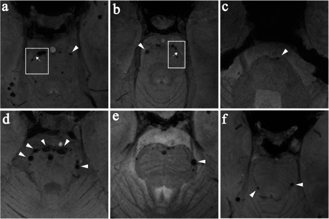 Diagnostic performance of "pons chocolate chip sign" in heterozygous HTRA1-related cerebral small vessel disease.