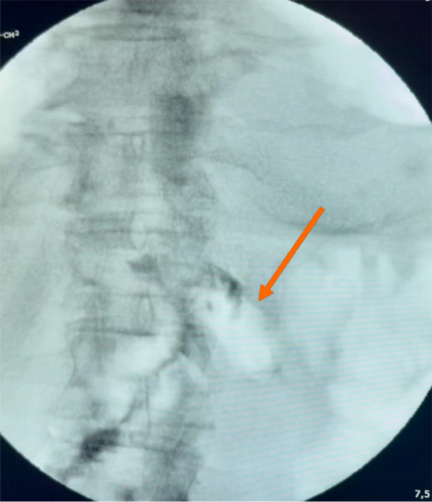 Isolation techniques for gastrointestinal tract defects: Two case reports.