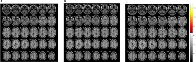 Exploring Facial Nucleus-Centered Connectivity in Hemifacial Spasm: Novel Insights into Pathogenesis and Surgical Impact.