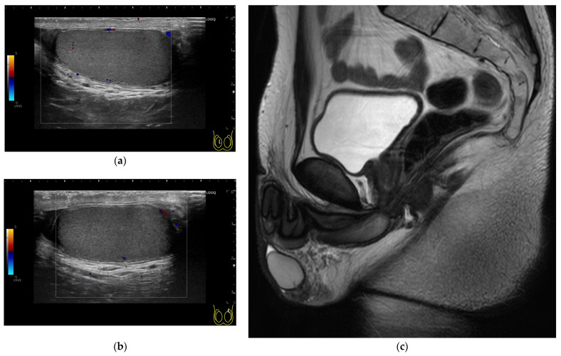 Comprehensive Fertility Management After Pituitary Adenoma Surgery: Lessons from a Rural Japanese Case and Practical Review.