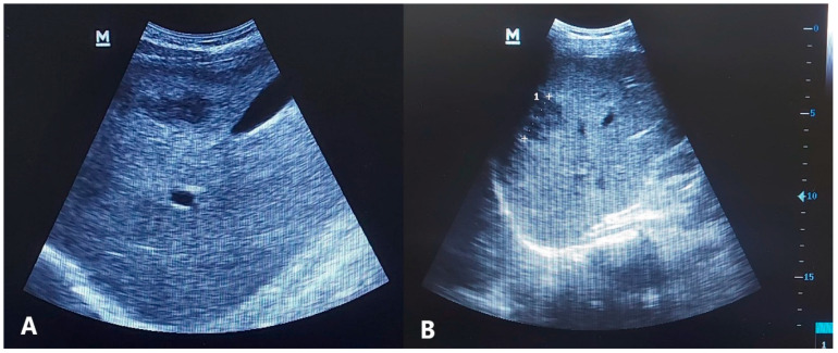High Efficacy of Triclabendazole/Ivermectin Combination Compared to Triclabendazole Monotherapy for Treating Human Fascioliasis in Upper Egypt: A Prospective Study.
