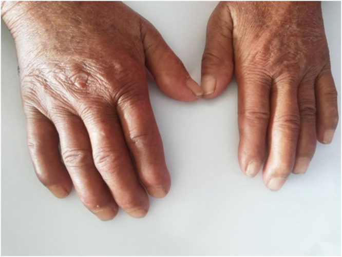 Cardiac tamponade with scleroderma renal crisis in systemic sclerosis: a case report.