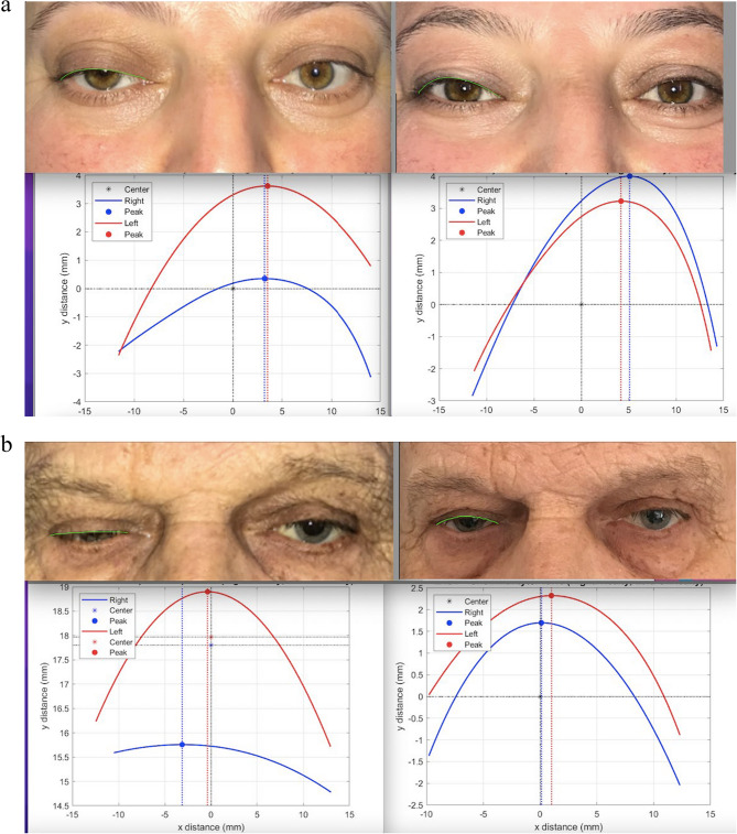 Comparison of eyelid contour symmetry after ptosis repair via centralized versus temporally biased levator suturing techniques.